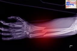 China Made Bone Glue : मिनिटांत जोडता येईल तुटलेली हाडं; जगातील पहिला ‘बोन ग्लू’ बनवणाऱ्या चीनचा दावा