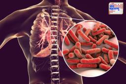 World TB Day:  जनजागृती आणि प्रतिबंधासाठी महत्त्वाचे पाऊल