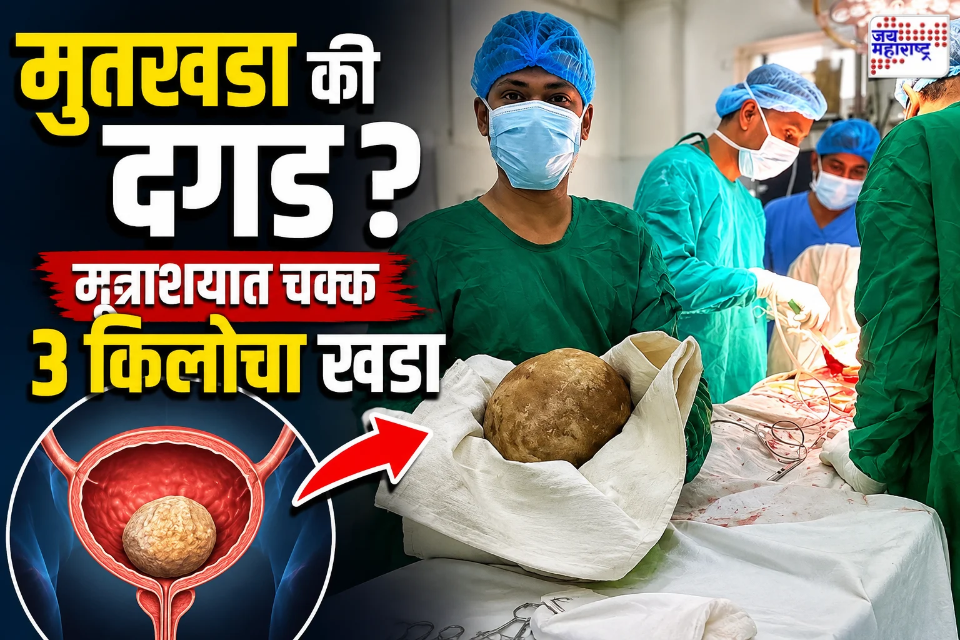 Stone In Bladder : वजन 3.1 किलो…लांबी 18.7 सेमी…, गर्भातील पूर्णवाढ झालेल्या बाळाइतक्या वजनाचा खडा मूत्राशयात; दुर्मिळ शस्त्रक्रीयेची सर्वत्र चर्चा