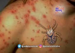 बुलडाण्यात स्क्रब टायफसचा शिरकाव